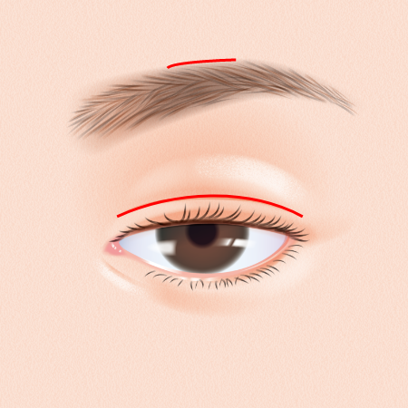 瞳孔を基準として①眉毛上縁と②睫毛上に切開線を決定します。