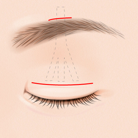 まぶたの開き具合を調節して筋膜を瞼板と眉毛上の皮下組織に固定します。